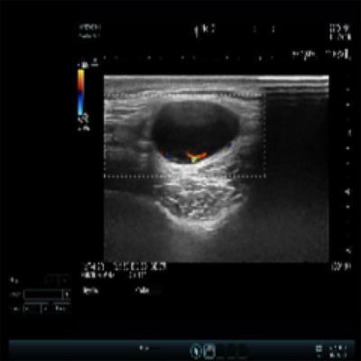 An adolescent with primary cutaneous follicle center lymphoma: a case report and literature review